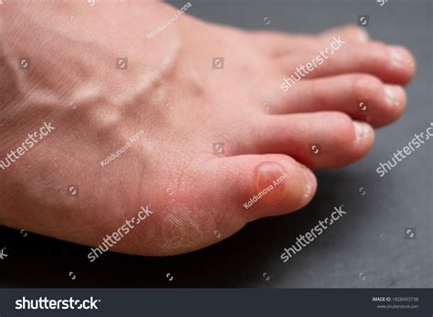 Callus On Pinky Toe