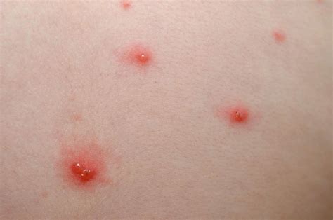 Wie sieht ein Herpes-Ausschlag aus? - MedDe