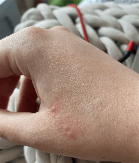 Woke up with tiny bumps all over both hands 2 days ago? (not itchy, no ...