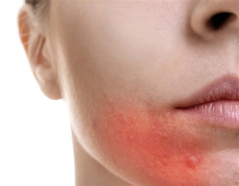 How To Take Care Of Beard Burn at Sharon Alexander blog