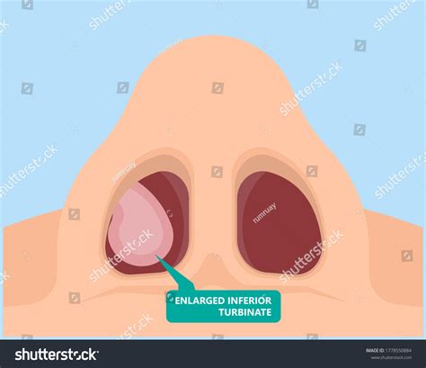 Pictures Of Enlarged Turbinates