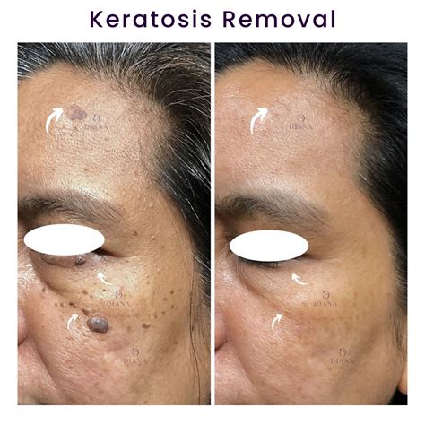 Seborrheic Keratosis Face Removal