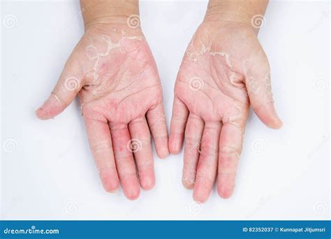 Newborn Baby Dry Skin Hands Feet at Samantha Hanlon blog
