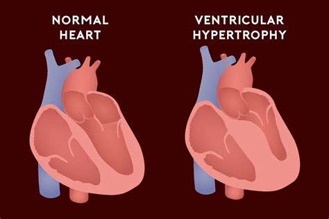 Ventricular Hypertrophy Anatomy, Function, And Dysfunction Of The RV