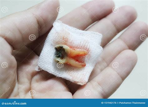 Decayed Molars, Tooth Extraction on the Hand Gauze Dental Health Check Stock Photo - Image of ...