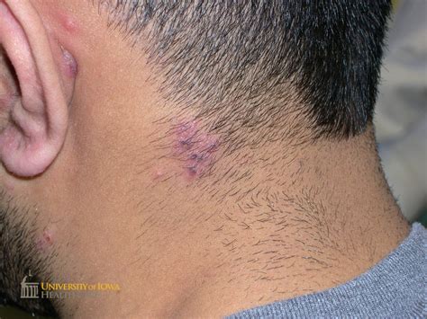 Grouped cloudy vesicles, some with central heme crusting, along the C3 dermatome . (click images ...