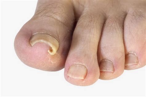 All About Involuted & Curved Toenails: Causes, Symptoms, and Treatment Options - Feet First Clinic