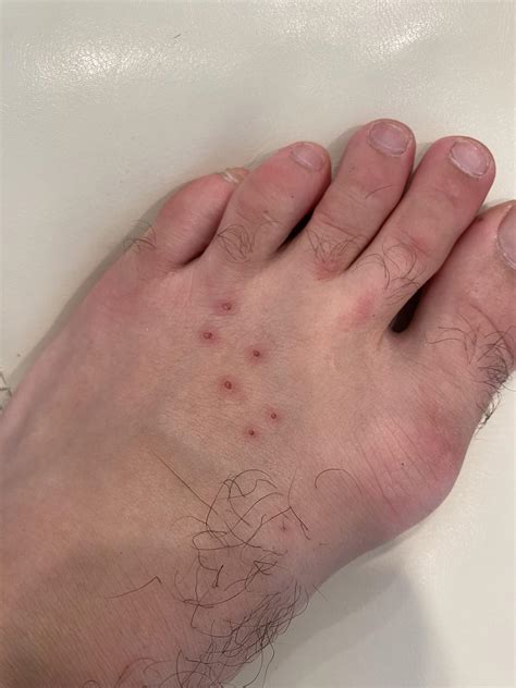 Bat Bite Statistics at Karen Evans blog