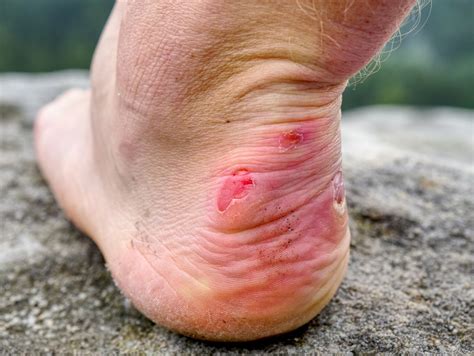 Wound Care Blisters at Karen Spaulding blog