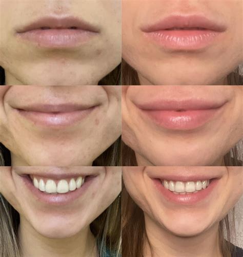 One syringe to correct my M-shaped lip : r/PlasticSurgery