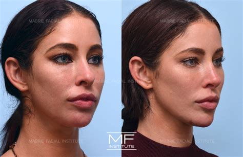 Correcting Previous Under Eye Filler Before and After Pictures Case 683 | San Francisco, CA ...