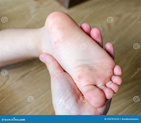 Enterovirus Feet Rash on the Body of a Child. Cocksackie Virus Rash ...