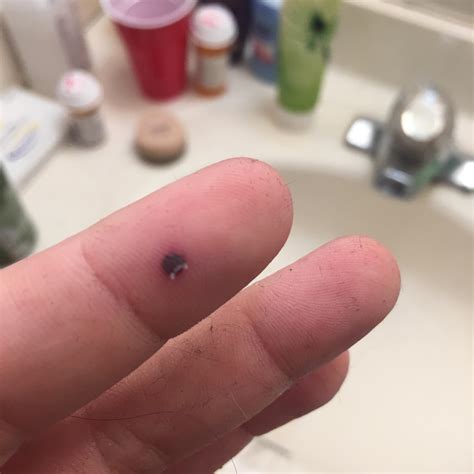 Got a blood blister at work. To pop or not to pop? : r/popping