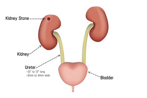 Passing A Kidney Stone Male