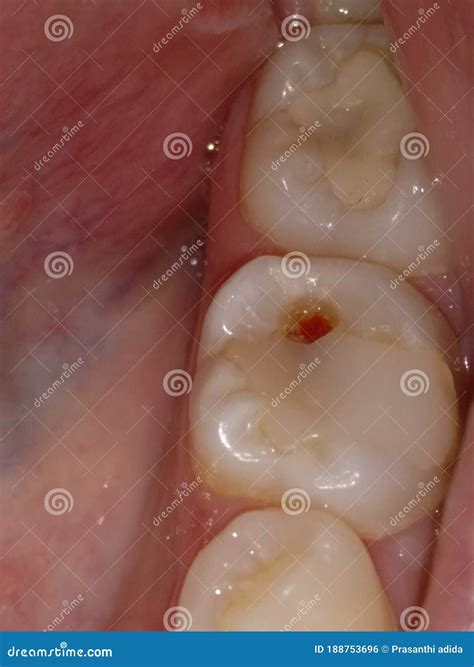 Dental Caries Into Pulp at Michael Wing blog