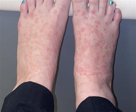 Itchy Rash on feet that is non responsive to Steroid creams. It’s been ...