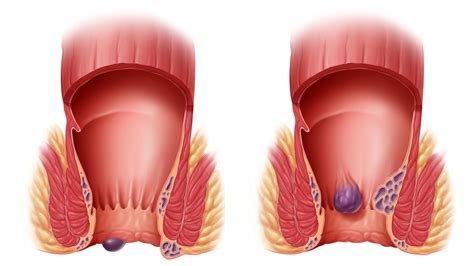 Can A Hemorrhoid Burst