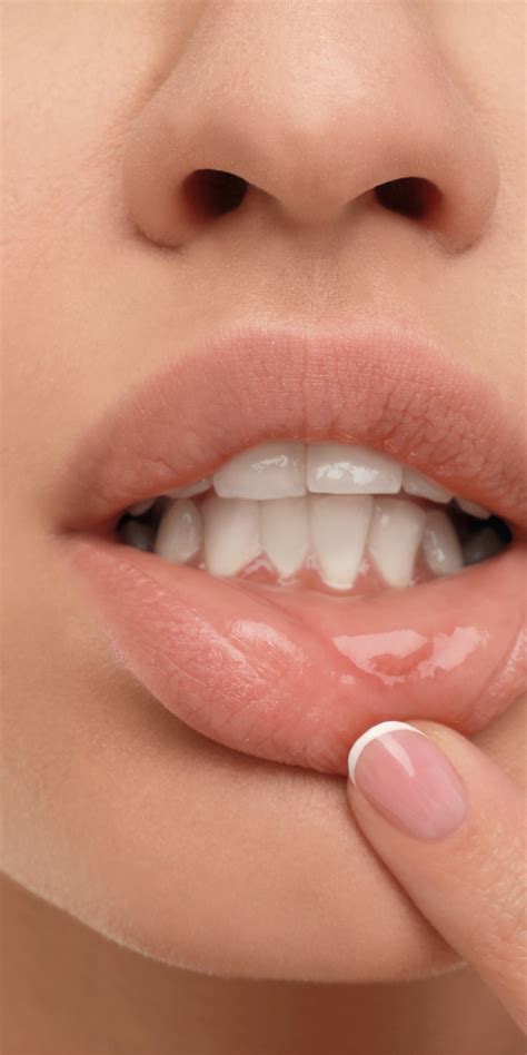 ¿Qué son las llagas en la boca? - Clínica Kranion