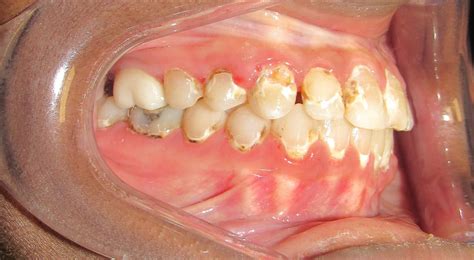 Can You Get Braces with Cavities? | Connolly Orthodontics in Ballantyne ...