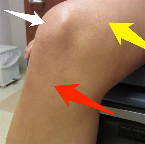 What Happens If You Fall On Your Kneecap at Brianna Carlo blog