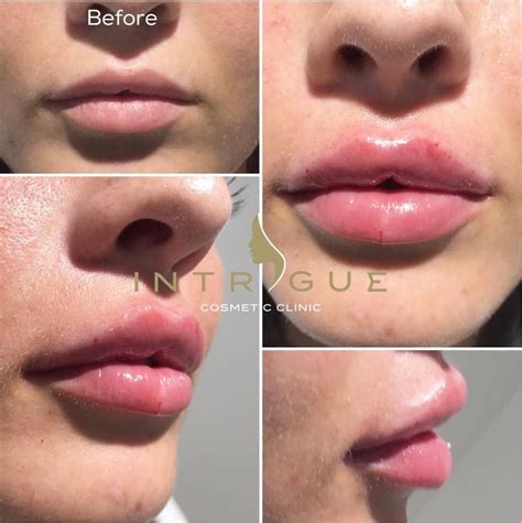 1Ml Lip Filler