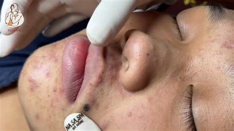 It's nice to have you back again great job! Blackhead removal with NaSa ...