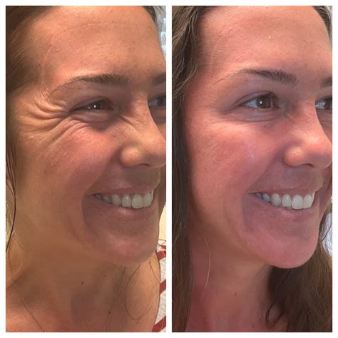 Injectables & Fillers | St. Johns Aesthetics St. Augustine FL