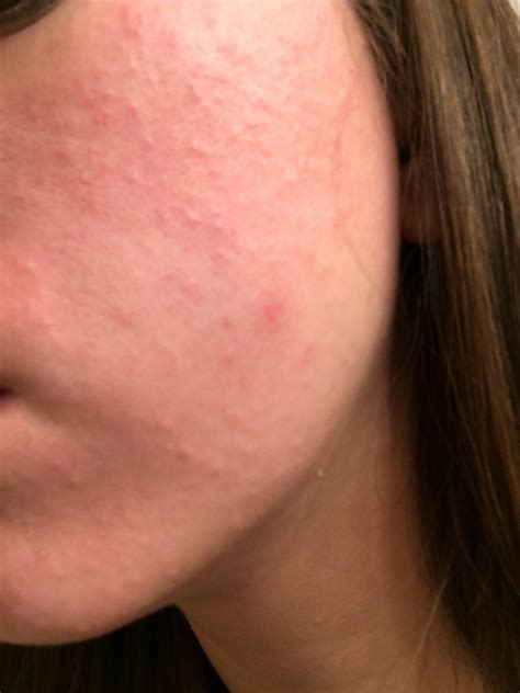 Why Is My Face Itchy With Rash at Roxana Longacre blog