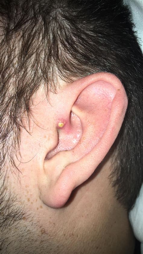 Huge pimple in boyfriends ear : r/popping