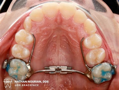 Removable Palatal Expander