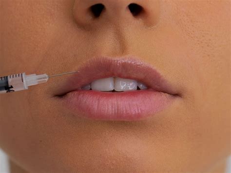Swedish Lip Filler: Subtle Scandinavian Results | Hubmed