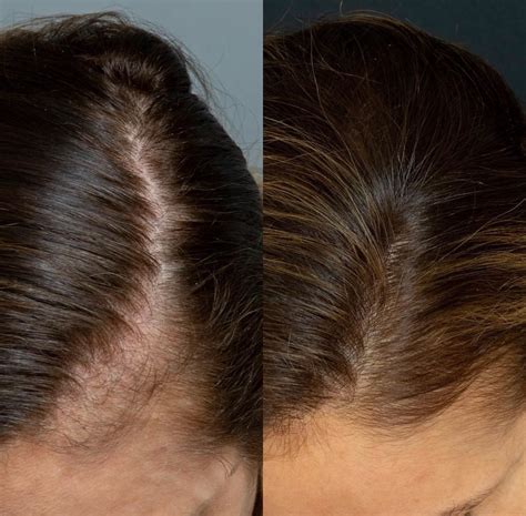 3D PRP Hair Treatment: Regrow & Strengthen Your Hair Naturally 3D Lifestyle PK