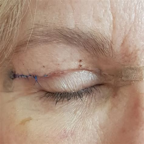 Ptosis (Droopy Eyelid) Treatment - Treasure Coast Eye Specialists