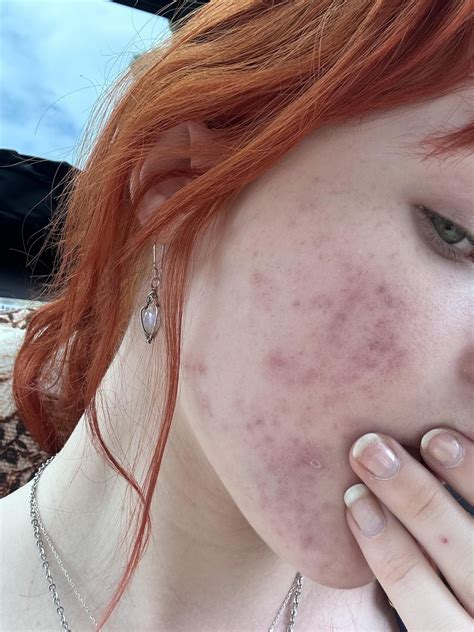 How can you tell if it’s going to scar? : r/Accutane