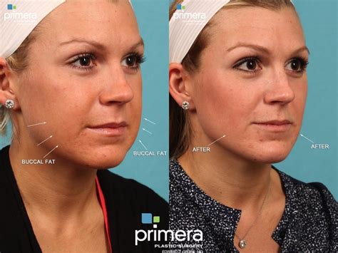 Face Fat Removal Without Surgery