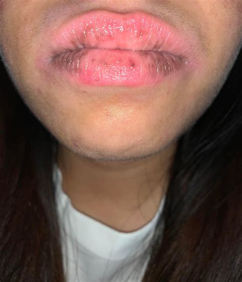 Why is there black patches and spot on my lips and how do I get rid of ...