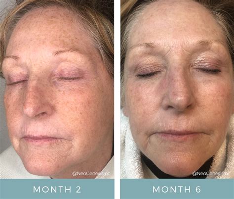 Chemotherapy Rash Before + After NeoGenesis Skin Care