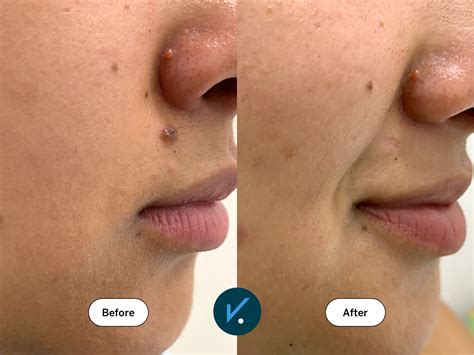 Flat Mole Removal Mole Removal Toronto | Safe Mole Removal Clinic In