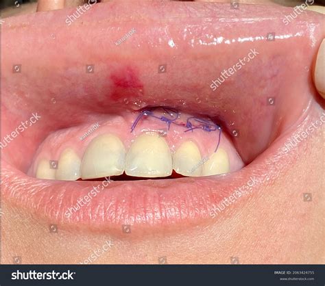 세포가 제거된 껌.수트된 껌잇몸과 치아의 질병 스톡 사진 2063424755 | Shutterstock