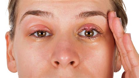 Swollen Eyelid with a Bump: Causes, Symptoms, and Treatments - A Comprehensive Guide - Swollen ...