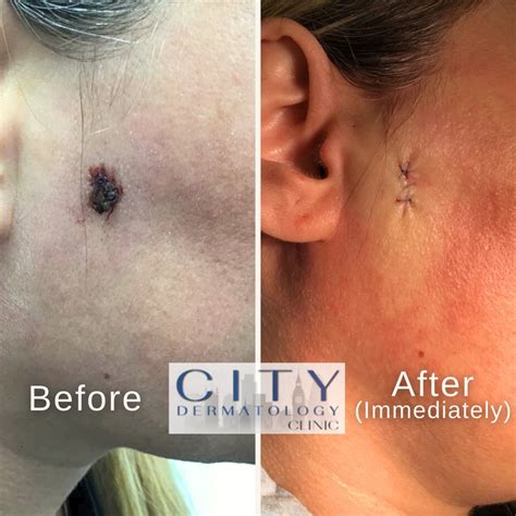 Before and After Photos Mole Removals