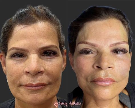 PDO Thread Lifting - Before and After Results at Skinly Aesthetics