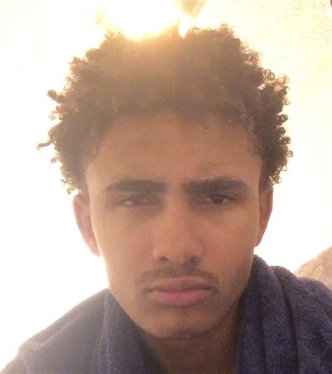 15 and recessed/ugly w/ upper eyelid exposure ——> 18 and still ugly but ...