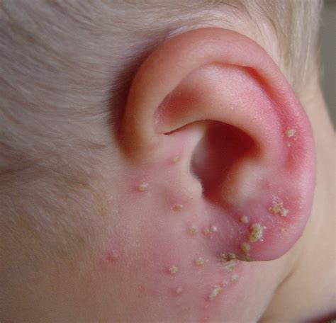 How To Treat A Ear Boil at Dylan Trouton blog