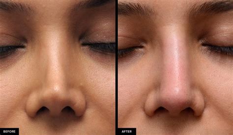 Bad Rhinoplasty Before And After