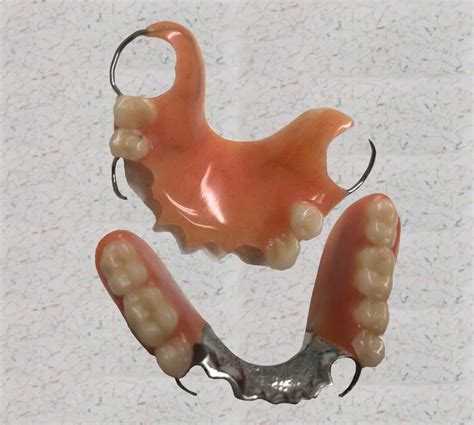 Removable Partial Denture Upper Removable Partial Dentures | Baluke