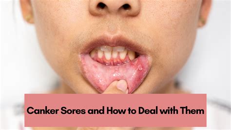 Canker Sores and How to Deal with Them