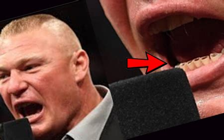 Dentist Brock Lesnar Teeth / Download Orthodontics Smile Teeth Dentist ...