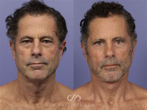 Before And After Plastic Surgery