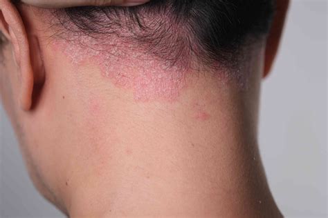 Why Do I Have a Rash on My Neck?